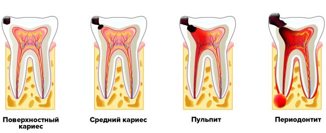Лечение кариеса Томск Измайловская Снимок зуба Томск Одесская